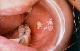 Salivary Gland Infection Market