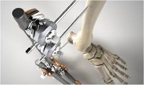 Trauma Fixation Device Market