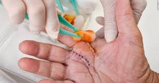 Wound Care Market