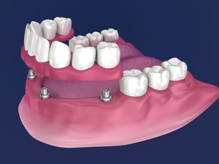 denture implants