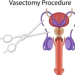Vasectomy and Management of Neuropathic Pain Using Nerve Blocks